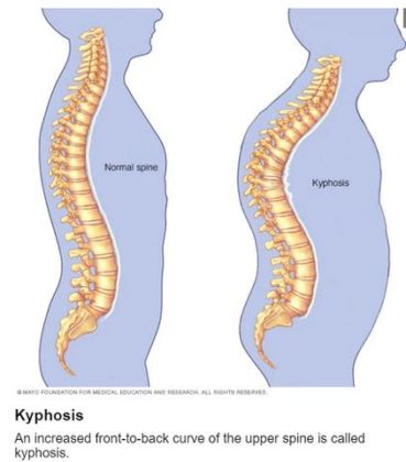 Что такое кифоз фото