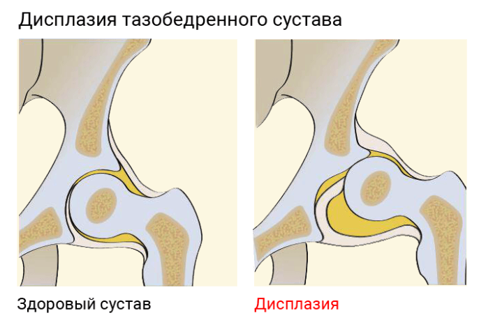 Имплант тазобедренного сустава фото