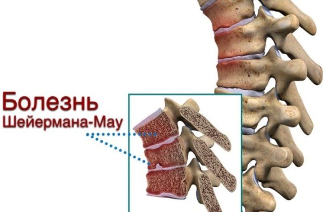 Болезнь шейермана фото